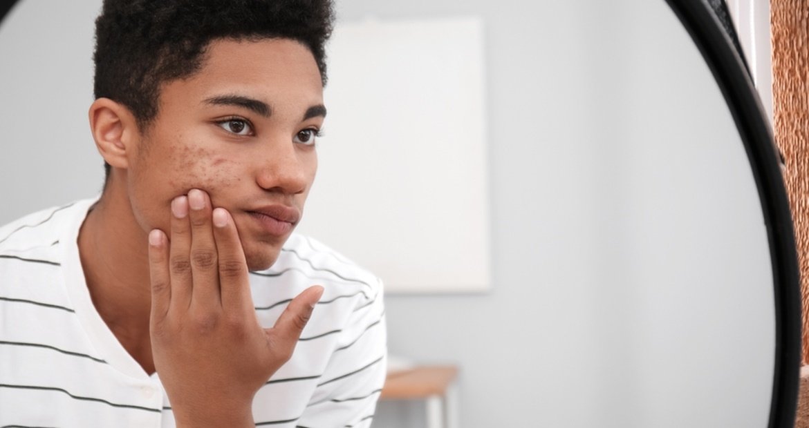 Manchas escuras na pele: acne ou espinhas